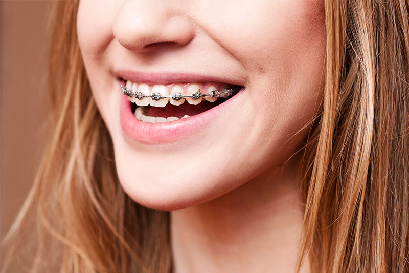 Orthodontics in San Mateo